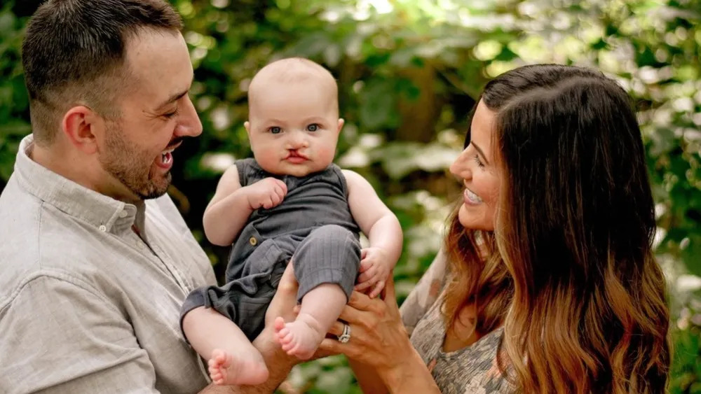 Cleft Lip and Palate: A Comprehensive Guide